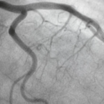 Angiographic View of Coronary Arteries