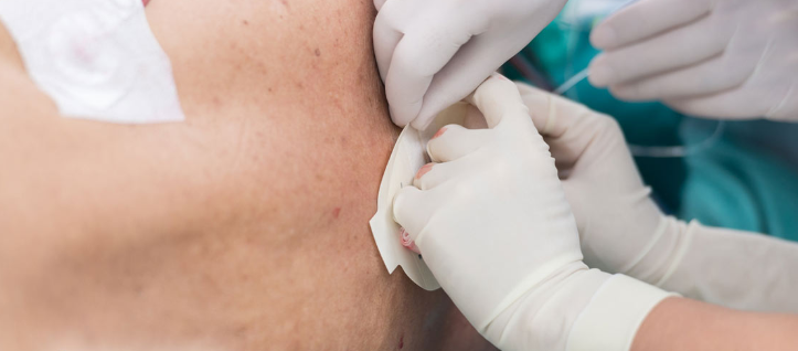 Sustained Pain Relief with Percutaneous 60-Day PNS in Chronic LBP